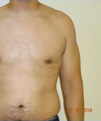 Torso of a person, facing forward. Light skin, exposed chest, and right arm visible.