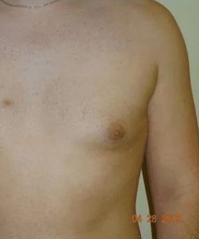 Torso of a person, showing a slightly prominent left breast. Light skin, indoors.