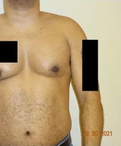 Torso of a person with dark skin. Black rectangles cover the chest and arm. Some hair is visible.