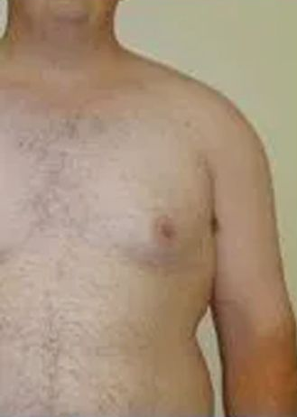 Torso with tan skin and some body hair. Right arm is tanned with lighter skin on the upper chest.