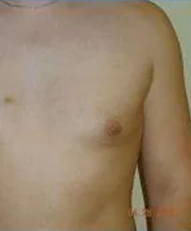 Torso of a person, showing chest and part of an arm, neutral skin tone.