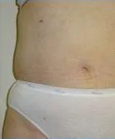 Abdomen in white underwear, showing a few small marks and a slight bulge.