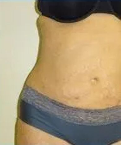 Torso of a person wearing a dark blue bra and underwear. Light skin with some stretch marks.