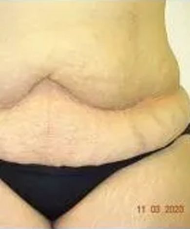 A person's abdomen, showing skin folds and stretch marks above a black underwear.