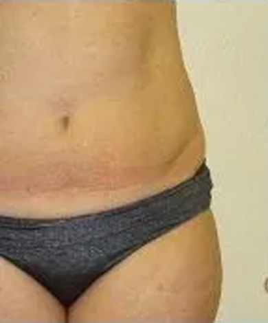 Torso of a person with a dark blue underwear, showing a pale abdomen with a pinkish line.