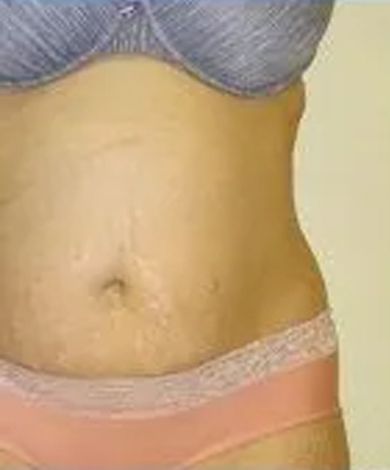 Torso in underwear; tan skin, navel, stretch marks, bra.