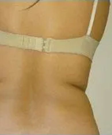 Close-up of a person's back, wearing a beige bra. Some skin folds visible.