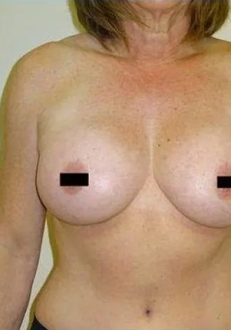 Torso of a person with bare breasts, chest, and shoulder. Skin has some discoloration.