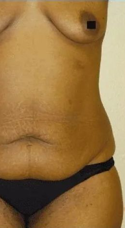 Torso of a person wearing black underwear, with stretch marks on abdomen. Dated 07 20 2021.