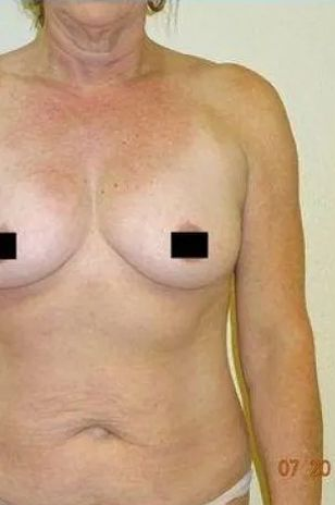 Torso of a person with tan lines. The breasts are covered by black boxes. Skin is visible.