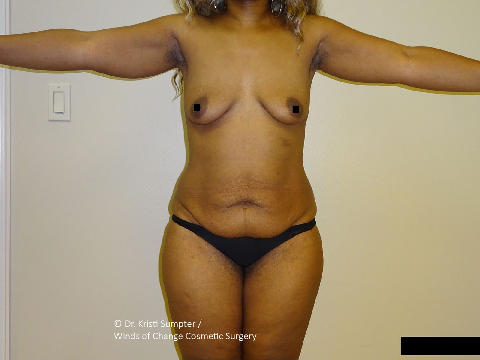 A front-facing view of a person’s torso and upper thighs against a plain wall, demonstrating visible skin laxity.