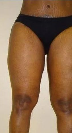 Close-up of a person's legs, wearing black underwear, against a neutral background. Skin has visible stretch marks.