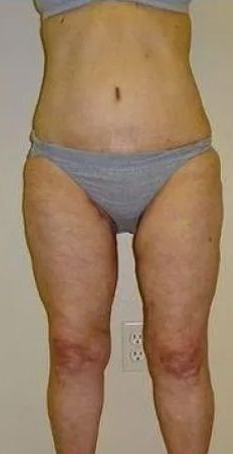 Person wearing gray underwear stands in front of a neutral wall; thighs show cellulite.