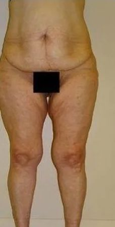 Person's body from waist to knees, in front of a plain wall. The abdomen and upper thighs are marked with lines. Date is visible in the corner.