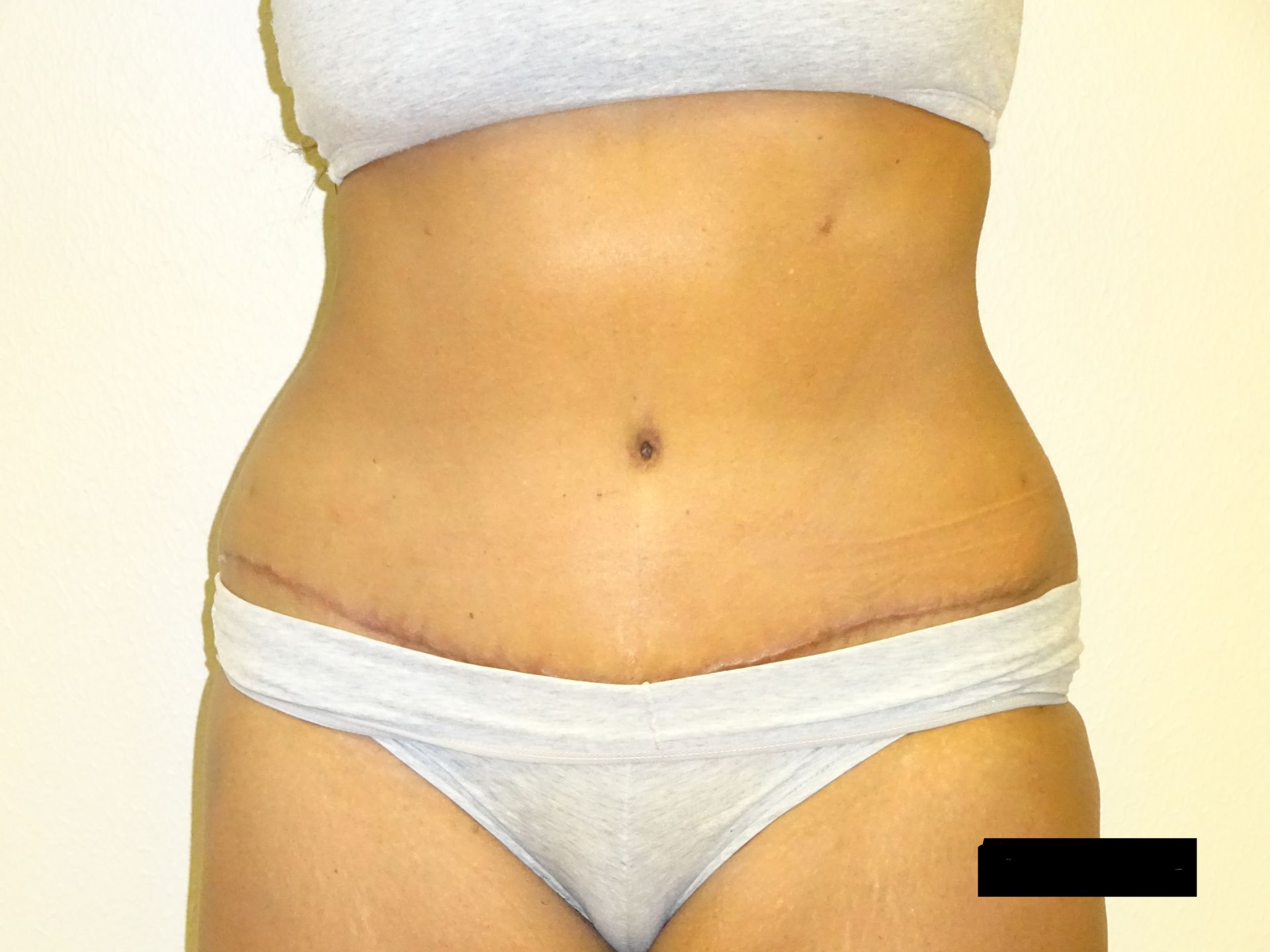Torso with surgical scars, wearing underwear and a top; belly button visible.