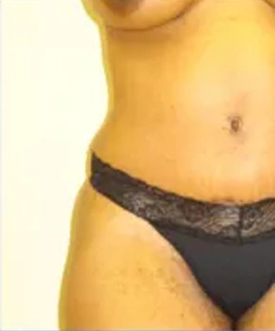 Torso of a person in black underwear against a light background.