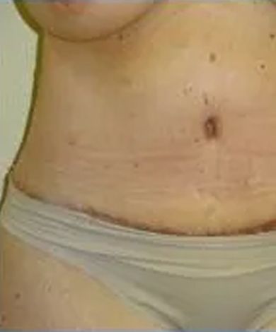 Torso with skin blemishes, wearing underwear.