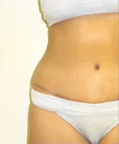 Torso of a person in white underwear, showing a lower abdominal scar.