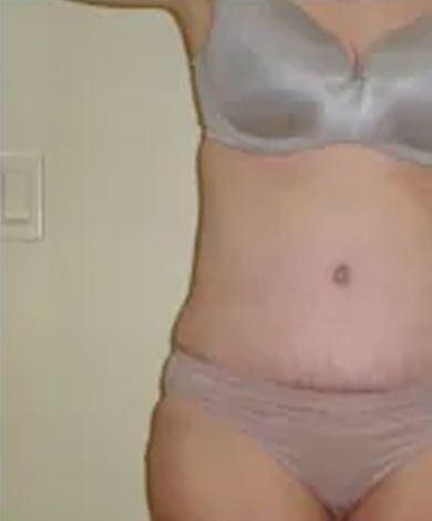 Torso of a person wearing a gray bra and pink underwear. Scars are visible below the navel.