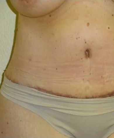 Torso with surgical scars on abdomen, wearing underwear. Skin tone is pale with several moles.