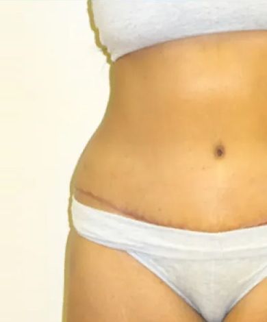 Woman's abdomen and hips. Shows a faded scar, wearing white underwear and a white top, against a pale yellow background.