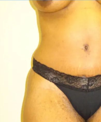 Person's torso wearing black lingerie, visible stomach with stretch marks, tan skin.