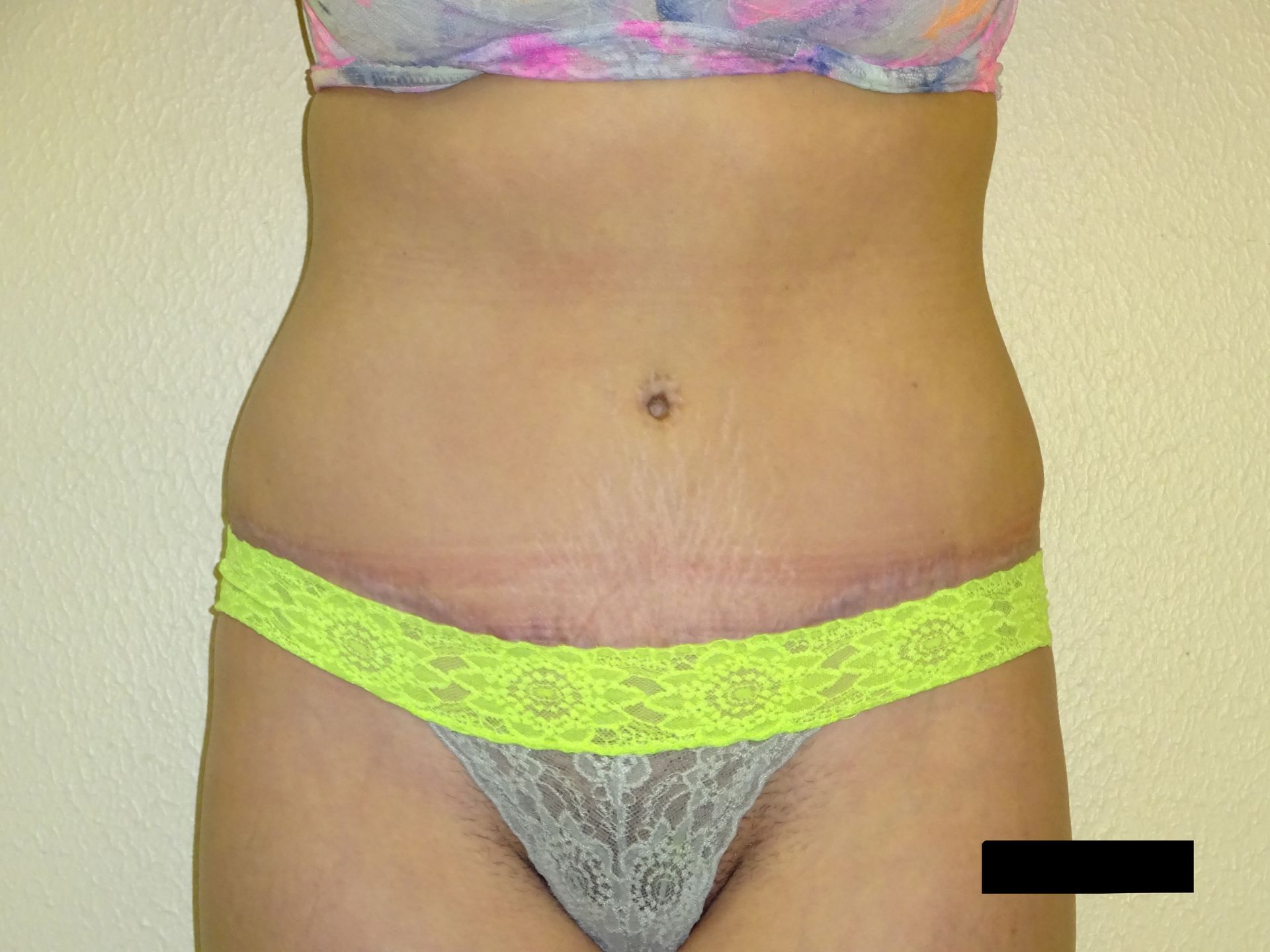 Torso of a person wearing a lacy thong and a bra. Visible stretch marks and a surgical scar on the abdomen.