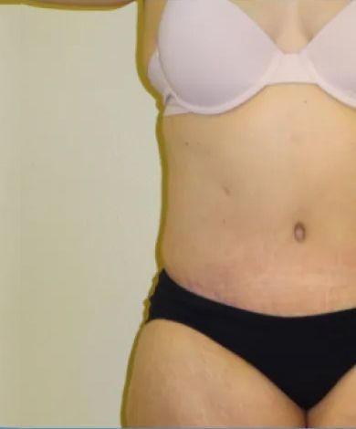 Torso of a person in white bra and black underwear, showing abdomen and thighs with stretch marks.