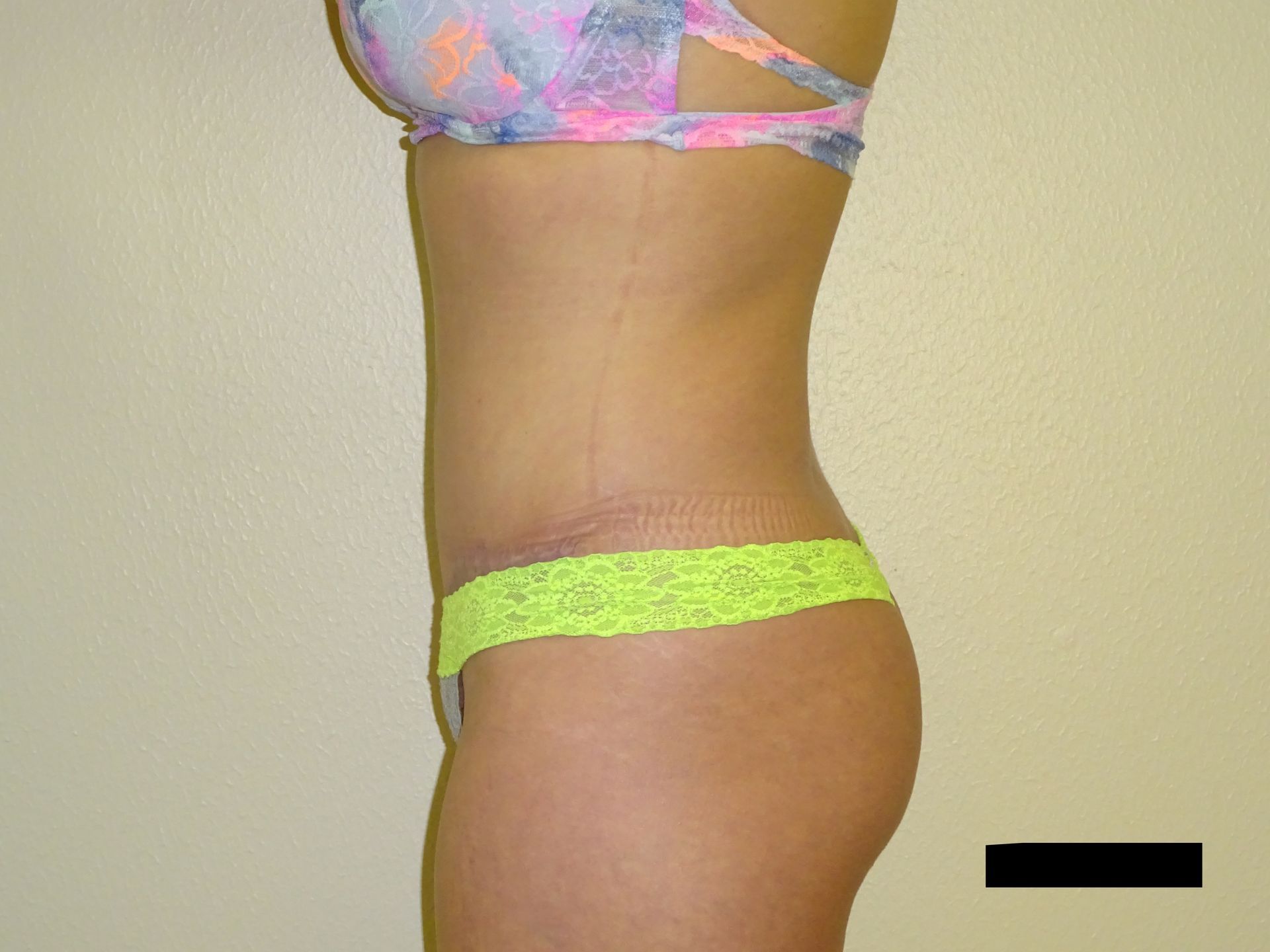 Person in underwear, side view, showing torso, hip, and buttock against a beige background.