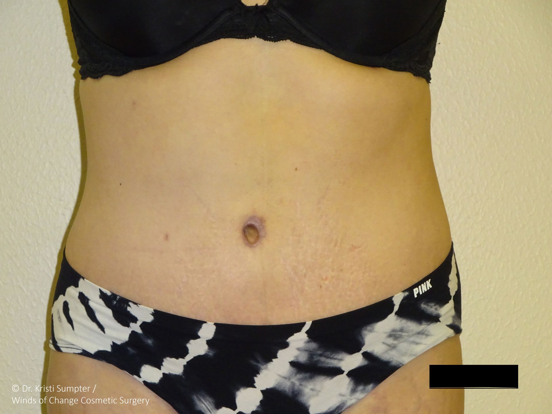 Abdomen with visible belly button piercing. Wearing black bra and patterned underwear.