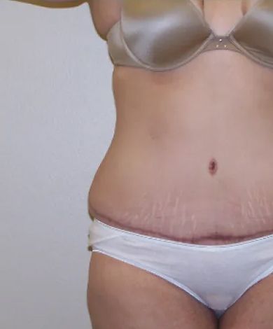 Torso in underwear showing post-surgical scar and stretch marks. Neutral skin tone, against a plain white background.
