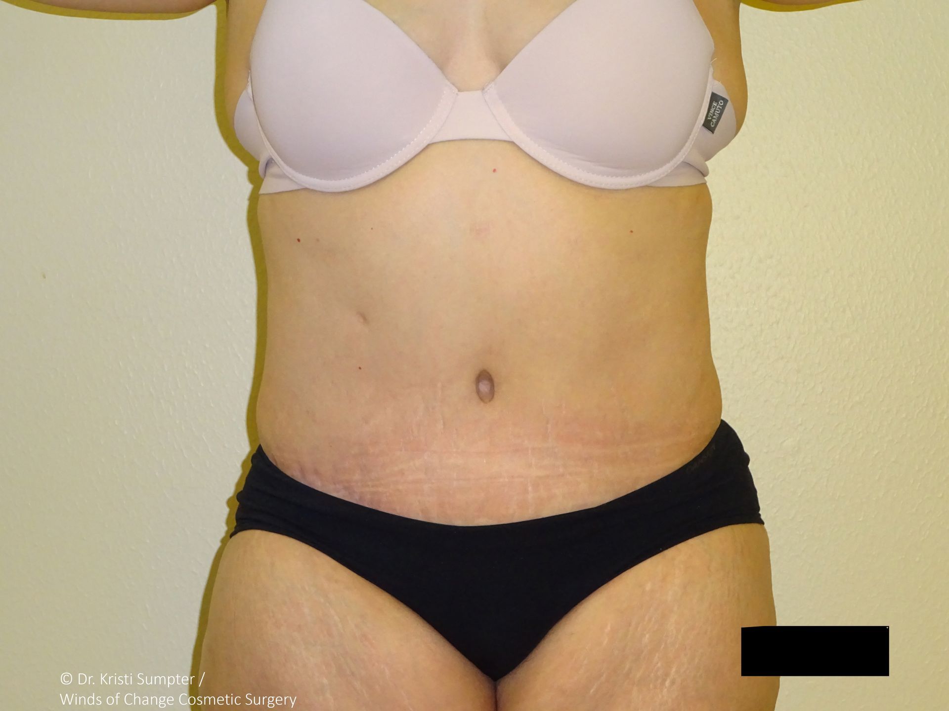 Woman in bra and underwear, arms raised. Visible stretch marks on abdomen and thighs.