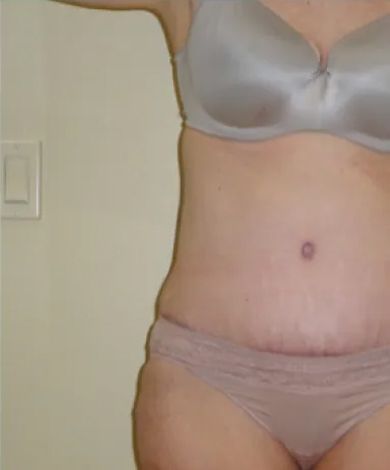 Woman in underwear and bra, showing torso. Light skin, scars on abdomen, in front of a wall.