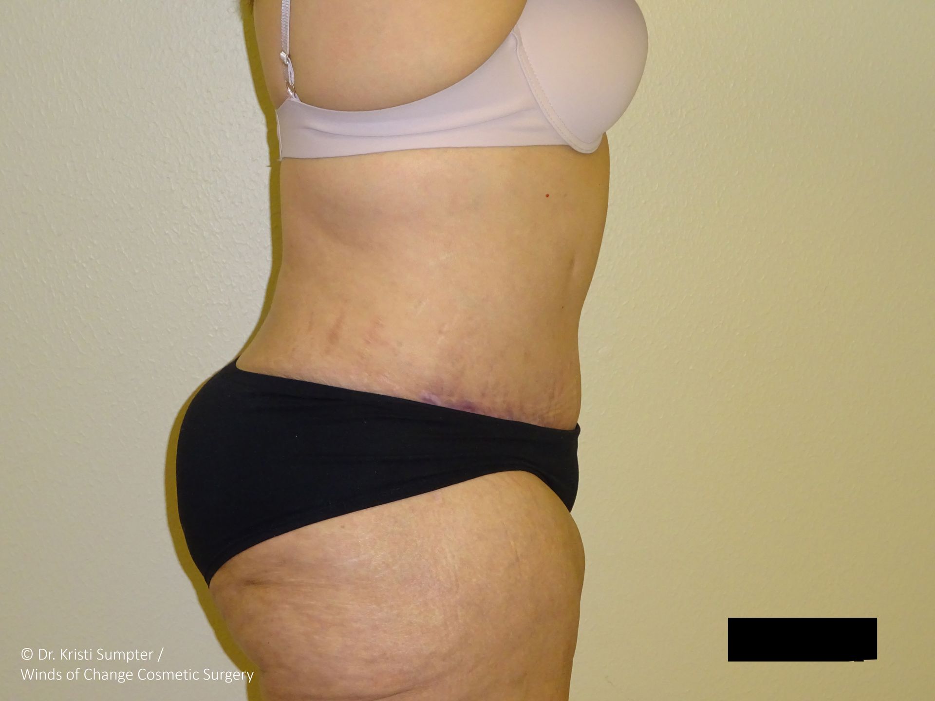 Side view of person in underwear, showing abdomen and buttocks with surgical scars.