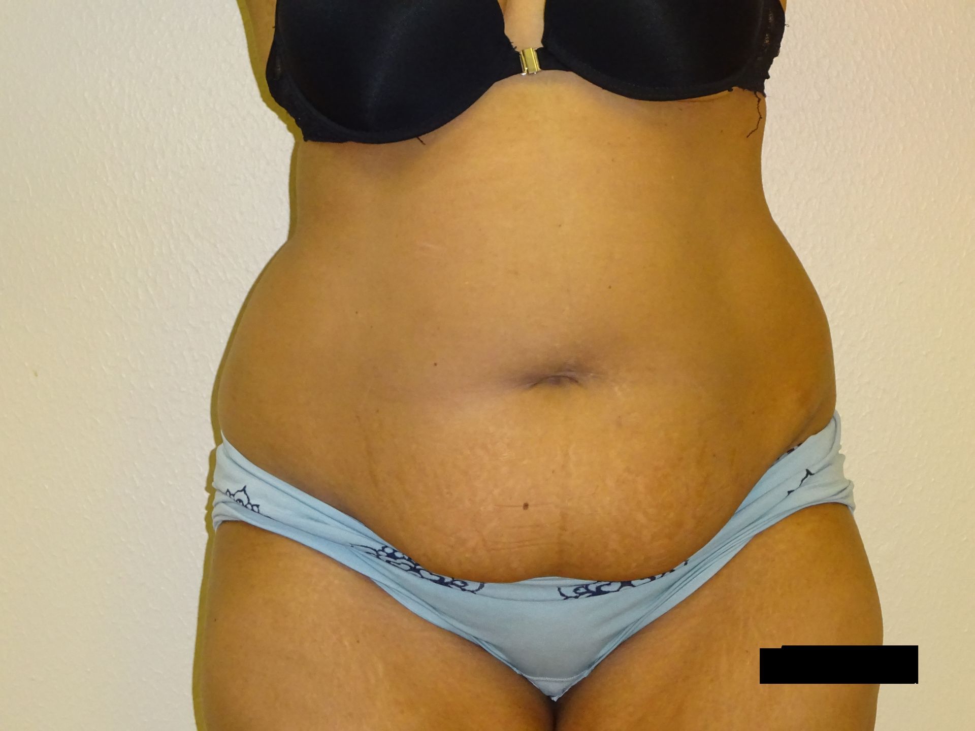 Torso of a person in underwear, showing skin with stretch marks.