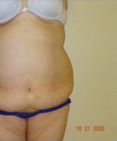 Torso wearing blue underwear and white bra, with a visible scar on the abdomen.