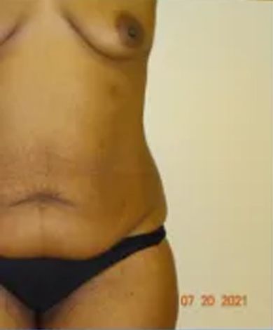 Torso of a person wearing black underwear, with a visible breast and a small amount of body hair.
