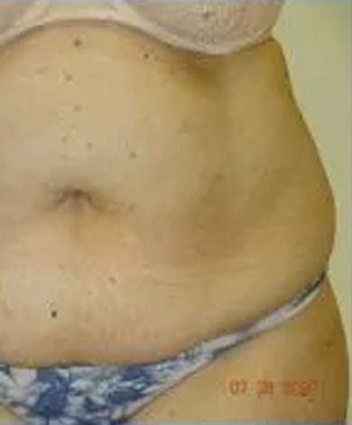 Close-up of a person's abdomen with a slight belly and wearing a bra and underwear.