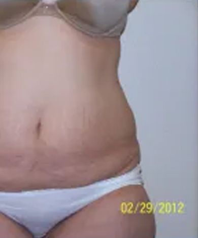 Close-up of a person's torso wearing a bra and underwear, showing stretch marks on the abdomen.