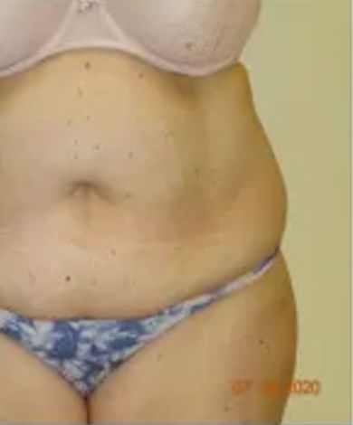 Torso of a person in underwear. The abdomen has a slight bulge, skin is light-toned.