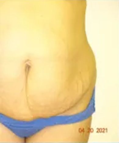 Abdomen in blue underwear, with loose skin and stretch marks. Date: April 20, 2021.