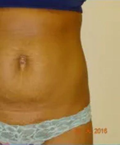 Close-up of a person's torso and lower abdomen in light blue underwear, showing stretch marks.
