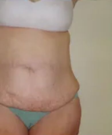 Abdomen of person with stretch marks and sagging skin, wearing a bra and underwear.