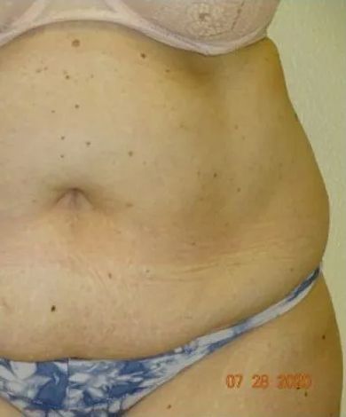 Torso of person with visible stretch marks, wearing bra and patterned underwear, dated July 28, 2020.