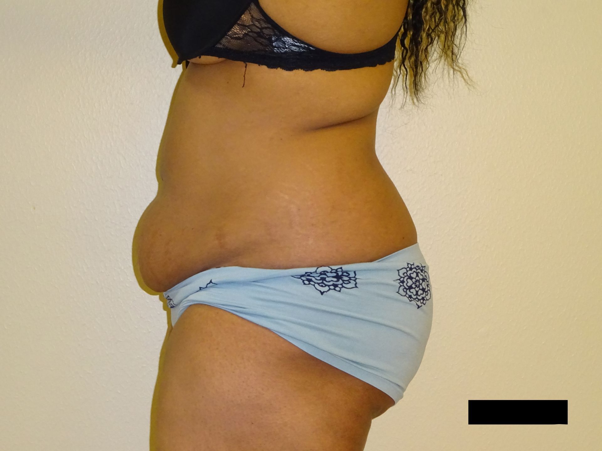 Side view of a person wearing a bra and underwear, showing their abdomen, with a bulge.