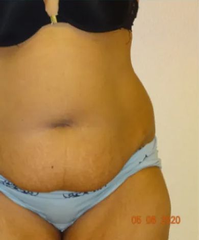 Person's midsection with stretch marks; wearing a black bra and blue underwear.