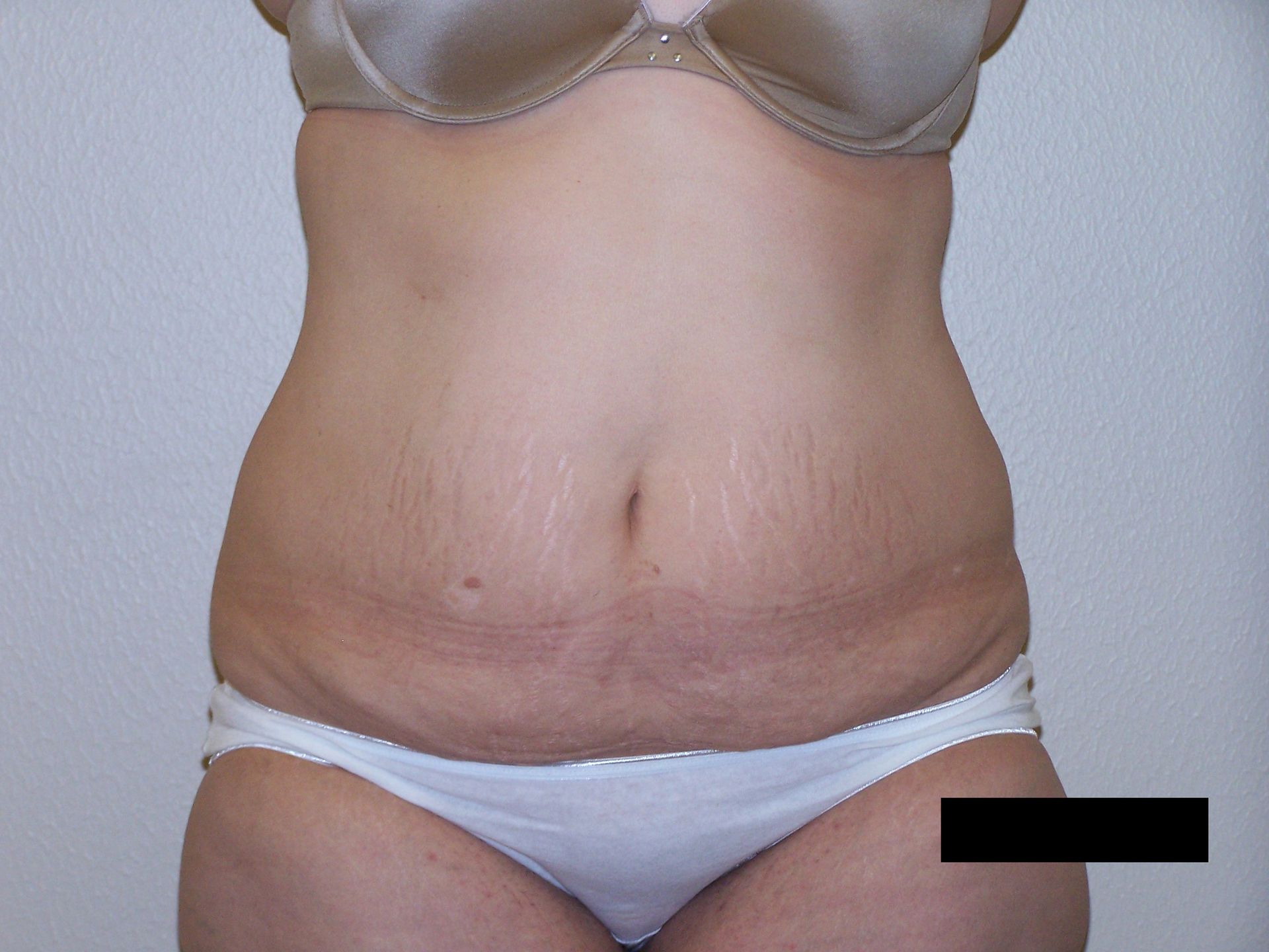 Torso of a person in underwear, showing skin with stretch marks.