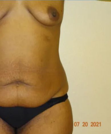 Torso with stretch marks, tan skin, black underwear, against a beige wall.