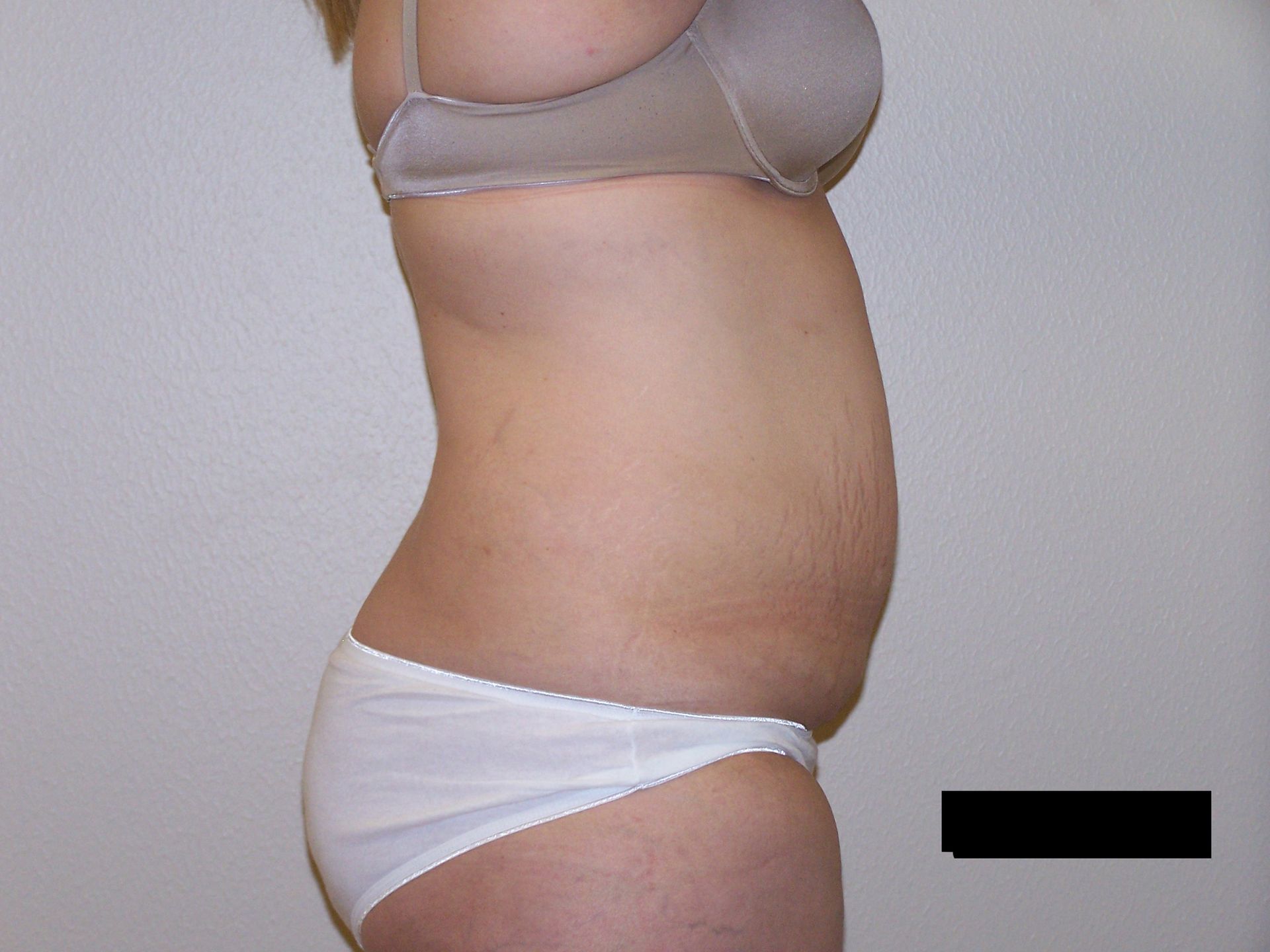 Side view of a person wearing a bra and underwear, showing their abdomen, with a bulge.