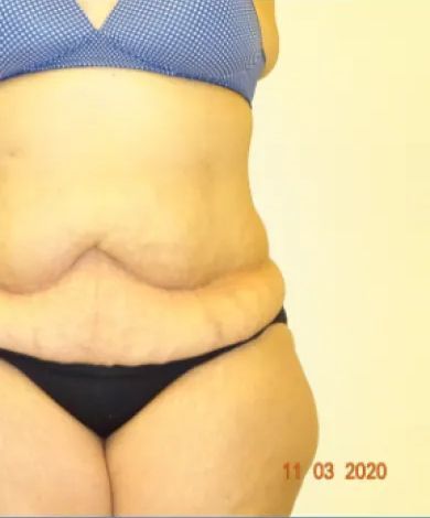 Woman's torso with loose skin in a blue polka dot bra and black underwear, side view, against a beige background.